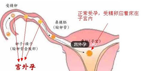 呼市人流|怀孕四个月可以无痛人流吗